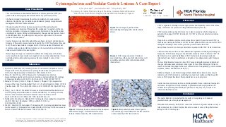Cytomegalovirus and Nodular Gastric Lesions: A Case Report