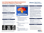 Low Grade Appendiceal Mucinous Neoplasm: Intraoperative Diagnosis of Tumor Origin by Sydney Parker, Caroline Keefer, and Robert Markus
