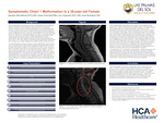 Symptomatic Chiari 1 Malformation in a 35-year-old Female by Ignatius Mmodebelu, Jaime Natividad, Jonathan Carpenter, and Juan Rodriguez