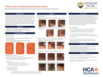 A Rare Case of Disseminated Herpes Zoster by Reza Nasrollahzadeh, Andrea Francis, Rasmeet Kaur, and Micheline Tantchou