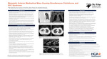 Metastatic Anterior Mediastinal Mass Causing Simultaneous Chylothorax and SVC Syndrome