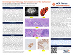 Unveiling a Rare Pathology: Carcinosarcoma of the Gallbladder by Gul Emek Wymer, Laci-Rae Pitter, and Susana Ferra