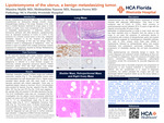 Lipoleiomyoma of the Uterus, a Benign Metastasizing Tumor by Munira Malik, Mohtashim Naeem, and Susana Ferra
