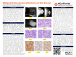 Malignant Adenomyoepithelioma of the Breast by Cole Daisley and Susana Ferra