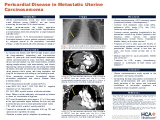Pericardial Disease in Metastatic Uterine Carcinosarcoma