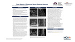 Case Report of Extensive Spinal Epidural Abscess by Eric Brown and Marcus Zorovich