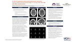 A Case Of Suspected Intracranial Granulocytic Sarcomas Versus Cerebrovascular Hemorrhage in a Young Male with CML with AML Transformation by Nicholas C. Rochester, Alicia C. McCartney, Amol S. Patel, Alexandra Kroes, Angelina Rodriguez, Napatkamon Ayutyanont, and Upinder Singh