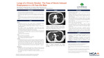 Lungs of a Chronic Smoker: The Case of Heroin Induced Emphysema in a 35-year-old Male by Neil Gerts, George Ishak, Ian Joel, and Jasprit Takher