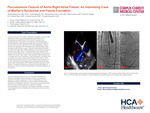 Percutaneous Closure of Aorto-Right Fistula: An Interesting Case of Marfan's Syndrome and Fistula Formation