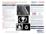 Thoracic Spine Lesion with Paralysis: A Rare Presentation of Plasmacytoma by Daniel Khashchuk and Natarajan Venkatayan