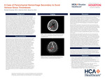A Case of Parenchymal Hemorrhade Secondary to Dural Venous Sinus Thrombosis by Parnia Forouzan, Jesse Cai, and Dewey Le