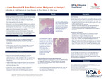 A Case Report of A Rare Skin Lesion: Malignant or Benign?