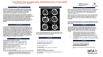 Case Report: Rare Neuropsychiatric Manifestations Seen in a SLE Patient