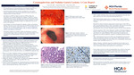 Cytomegalovirus and Nodular Gastric Lesions: A Case Report by Tyler Jones, Daniel Bishev, and Vidya Kollu