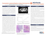 Paraneoplastic Leukemoid Reaction in Uterus Carcinosarcoma by Xiaolan Tang, Ashali Jain, Uma Iyer, and Jennifer Reppucci