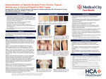 Presentations of Cutaneous Disease in Various Skin Pigmentations: Steroid Atrophy