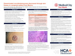 Disseminated coccidioidomycosis discovered through skin biopsy in a pregnant patient from Mexico
