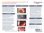 A Rare Case of Invasive Adenocarcinoma of the Duodenum and a Bovel Biliary Stent: A Case Report