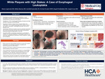 White Plaques with High Stakes: A Case of Esophageal Leukoplakia