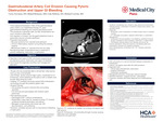Gastroduodenal Artery Coil Erosion Causing Pyloric Obstruction and Upper GI Bleeding