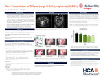 Rare Presentation of Diffuse B-Cell Lymphoma (DLBCL)
