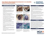 Case Report: Disseminated Mucormycosis in an Ostensibly Immunocompetent Patient by Chad Froes, Matt Gellatly, and Brian Watson