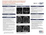 Ultrasound and MRI Findings of Meningococcal Meningitis Complicated by Subdural Empyema Formation in a 2-Month Old by Nicholas Fuerstenau, Adam Golembioski, Neal Hall, and Dhruv Patel