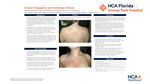 A Case of Aquagenic and Cholinergic Urticaria by Marilian A. Canals Rivera, Kyle Rauch, Amanda Brenner, and Victoria Charry