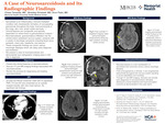 A Case of Neurosarcoidosis and its Radiographic Findings by Chase Tenewitz, Brantley Grimball, and Druv Patel