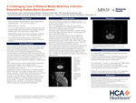 A Challenging Case of Bilateral Medial Medullary Infarction Resembling Guillain-Barré Syndrome by Alexis Bialousz, Havird McLean Skalak, Nicholas Carbo, and Amanda Westbrook