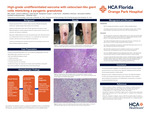 High-grade Undifferentiated Sarcoma with Osteoclast-like Giant Cells Mimicking a Pyogenic Granuloma