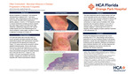 Often Overlooked: Microbial Influence in Disease Progression of Mycosis Fungoides