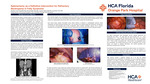 Splenectomy as a Definitive Intervention for Refractory Neutropenia in Felty Syndrome