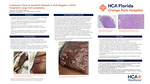 Cutaneous Clues to Systemic Relapse in ALK-Negative, CD30+ Anaplastic Large Cell Lymphoma