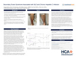 Secondary Evans Syndrome Associated with SLE and Chronic Hepatitis C Infection