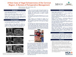 A Rare Case of Vagal Schwannoma of the Cervical Region: A Review of Perioperative Management