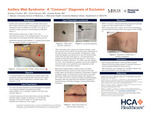 Axillary Web Syndrome:  A “Common” Diagnosis of Exclusion