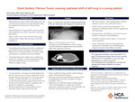 Giant Solitary Fibrous Tumor causing cephalad shift of left lung in a young patient