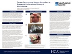 Corpus Cavernosum Abscess Secondary to Traumatic Perforation of Urethral Diverticulum
