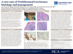 A Rare Case of Trichilemmal Carcinoma: Histology and Management