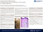 Segmental Neurofibromatosis: Isolated Eruption of Neurofibromas on the Scapula in a Middle-Aged Man