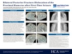 Bilateral Posterior Fracture-Dislocation of the Proximal Humerus After First-Time Seizure by John D. Murphy, Phillip Braunlich, and Mohit Bansal