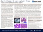Cervical Cancer Recurrence in the Colon