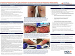 Pyoderma Gangrenosum as an Initial Presentation of Rheumatoid Arthritis & Inflammatory Bowel Disease by Julian Reoyo, Jennifer Cucalon, Milton Alexis Torres, Toni Feghali, Francia Guerrero, Joseph Pino, and Shahid Sulaiman
