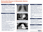 Pericardial Disease in Metastatic Uterine Carcinosarcoma by Dalena Thai, Mario Lavelanet, and Mark Stine
