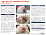 Slow Mohs for Sebaceous Carcinoma of the Scalp by Heather Kopecky, Angela Rosenburg, Brett Thomas, and Richard Miller